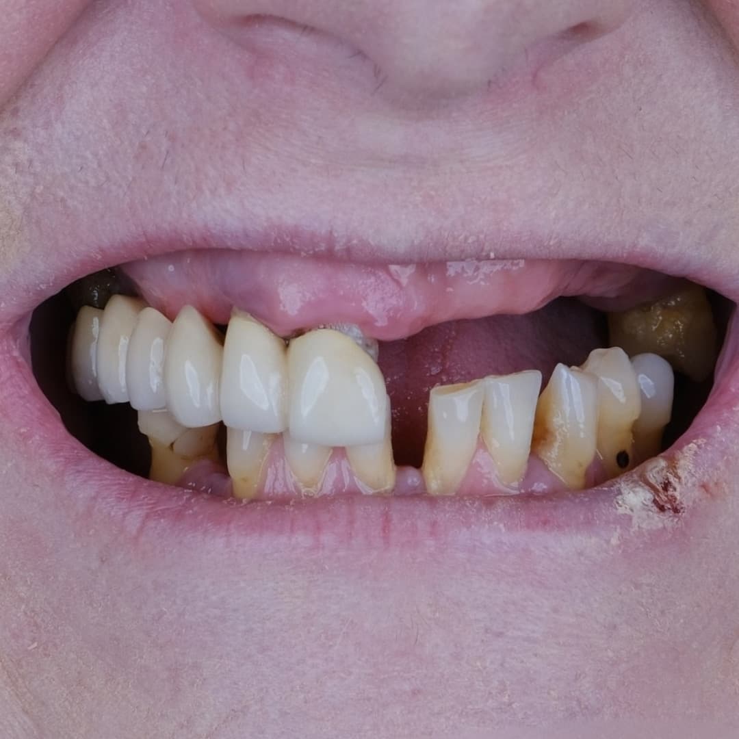 Smile Makeover with Zirconium Crowns, before