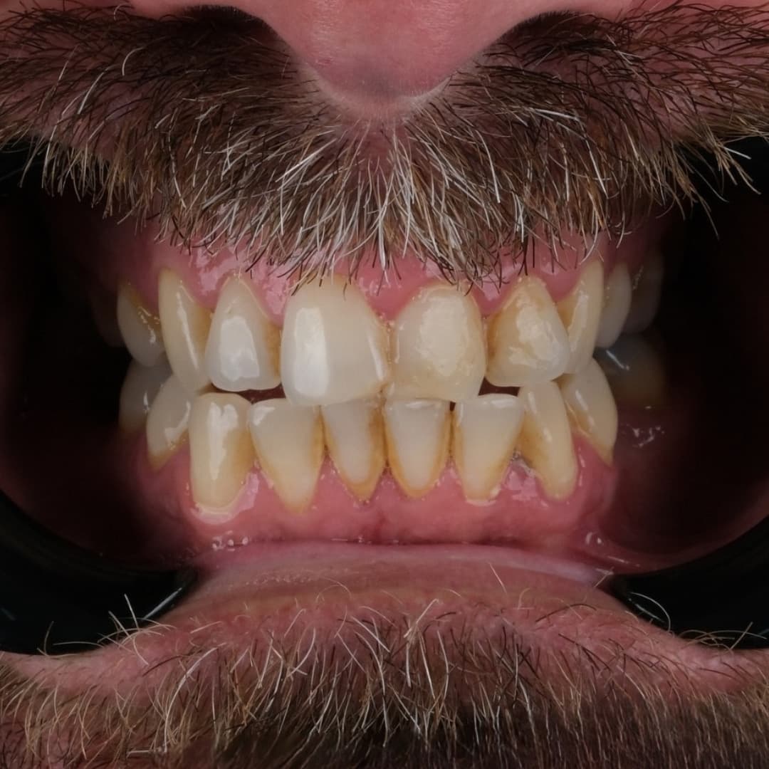 E-max Non Prep / Prep Veneers, before
