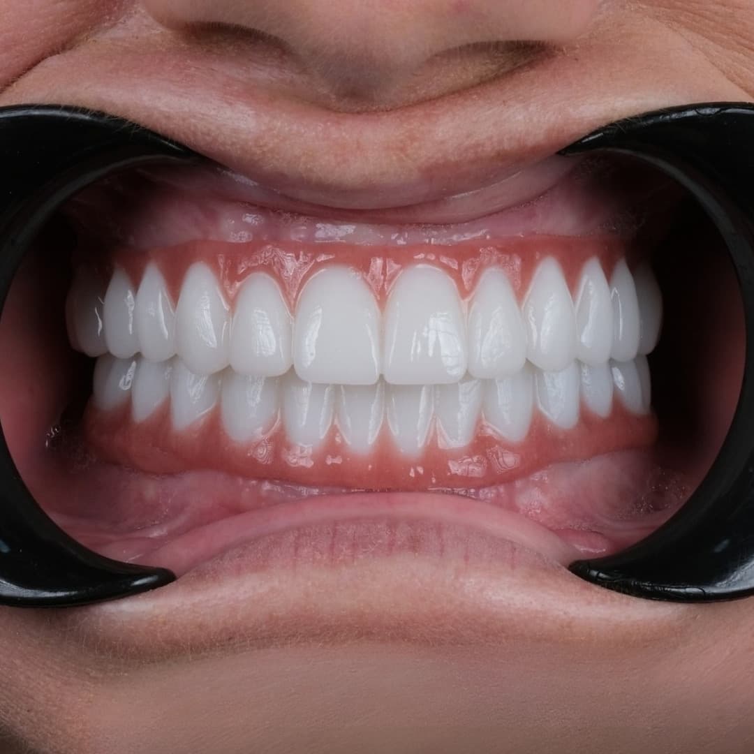 All-on-4 Vs All-on-6 Dental Implants: Which One Is Right for You?