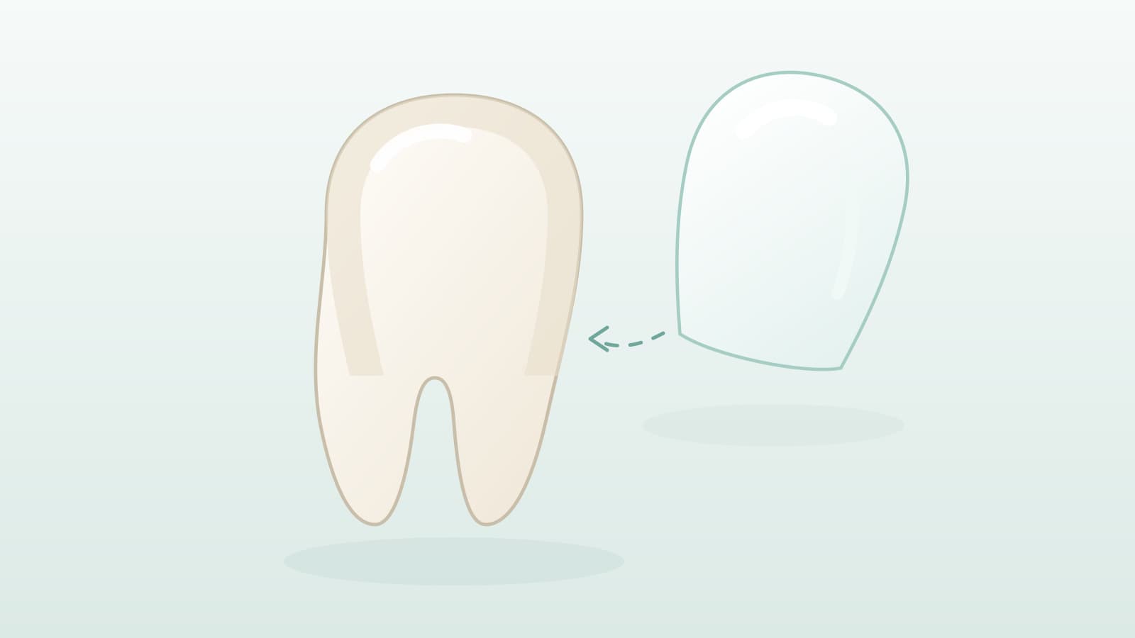 Do Aesthetic Veneers Shorten the Life of Your Original Teeth?
