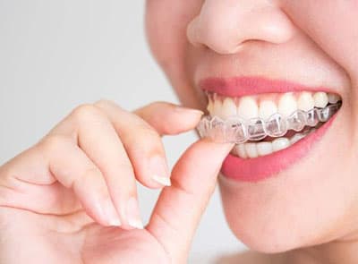 Invisalign Clear Aligners: How They Work and Who They're For