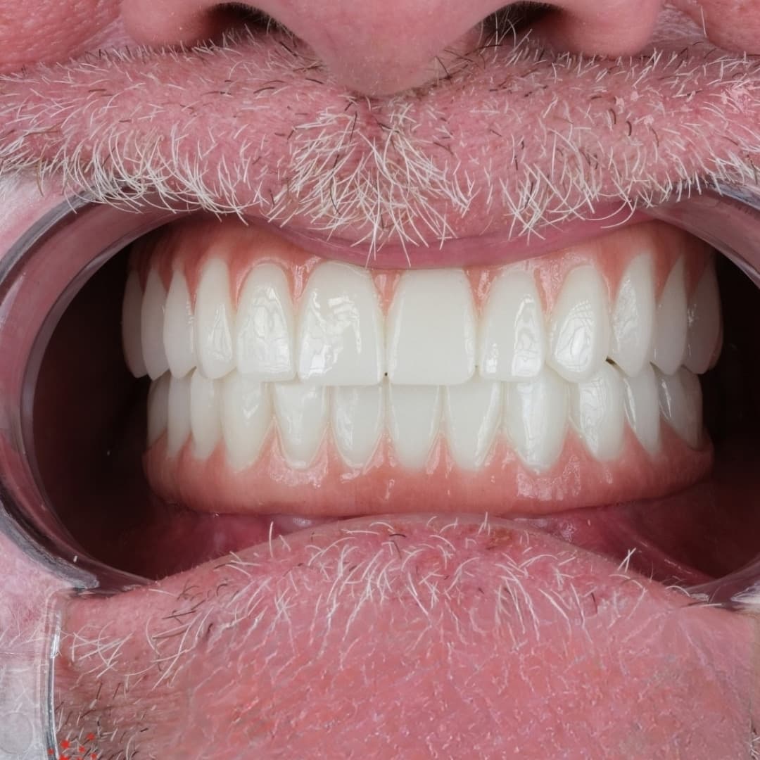 What is screwless dental implants?