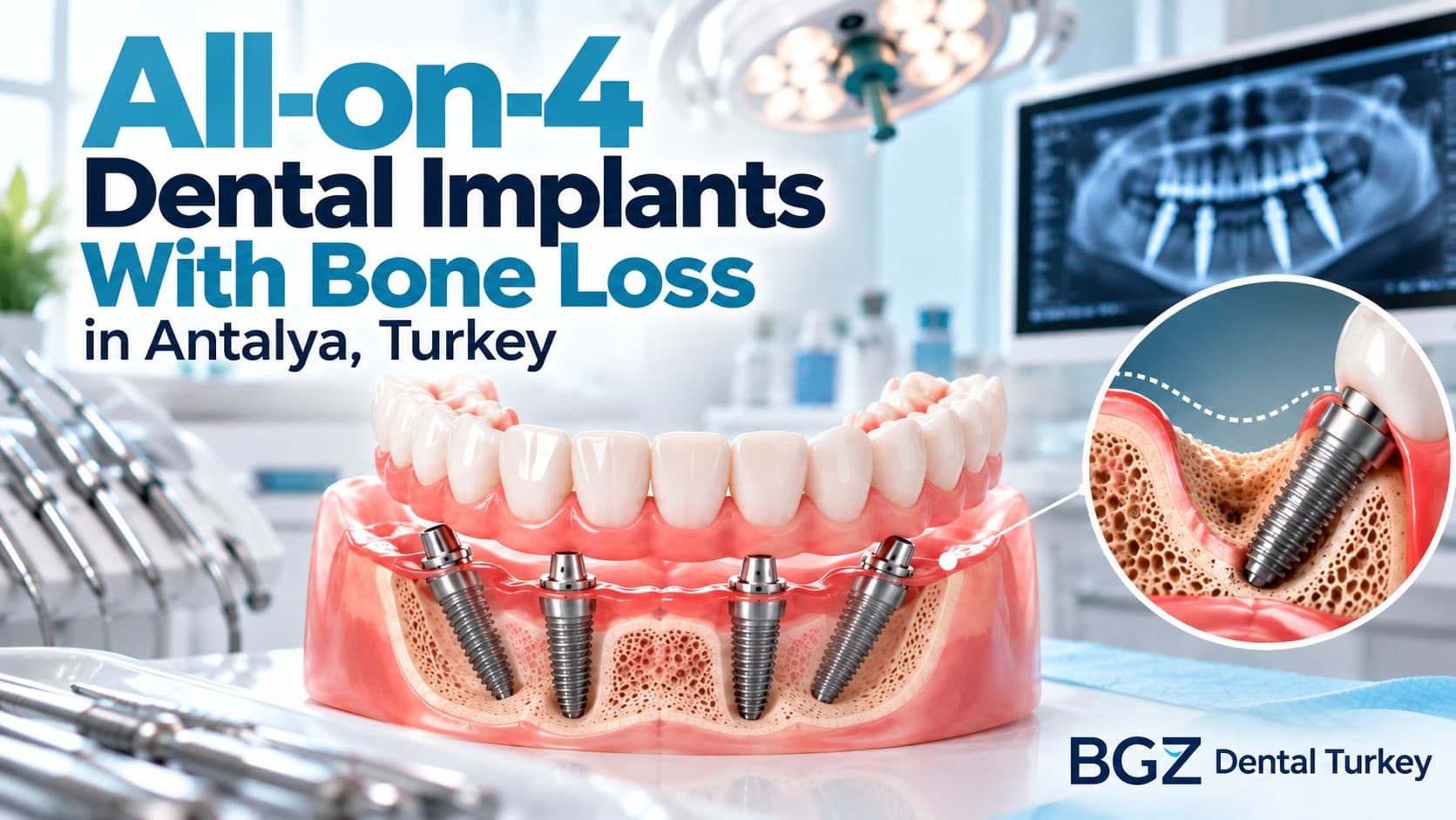 All-on-4 Dental Implants With Bone Loss in Antalya, Turkey All-on-4 Dental Implants With Bone Loss in Antalya, Turkey
