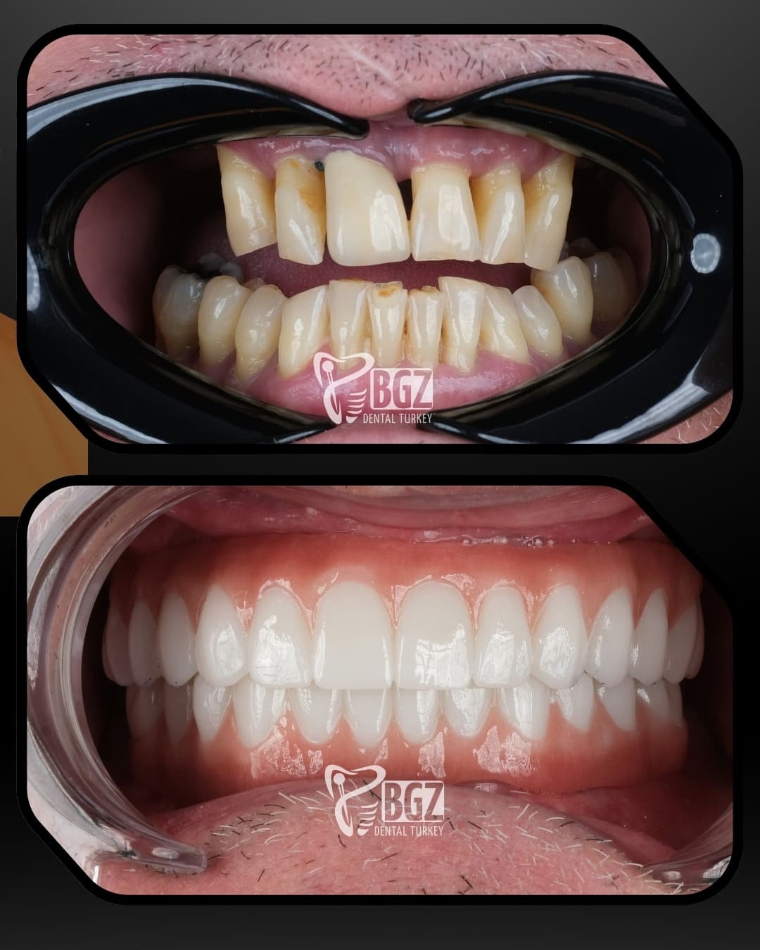 all-on-4-before-after-antalya-turkey all-on-4-before-after-antalya-turkey