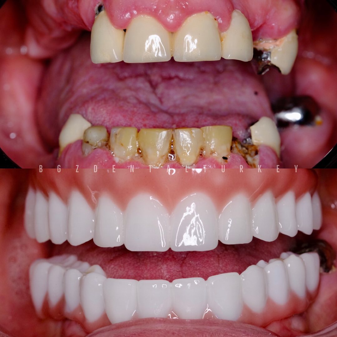 Before & after all on four dental implants in Antalya