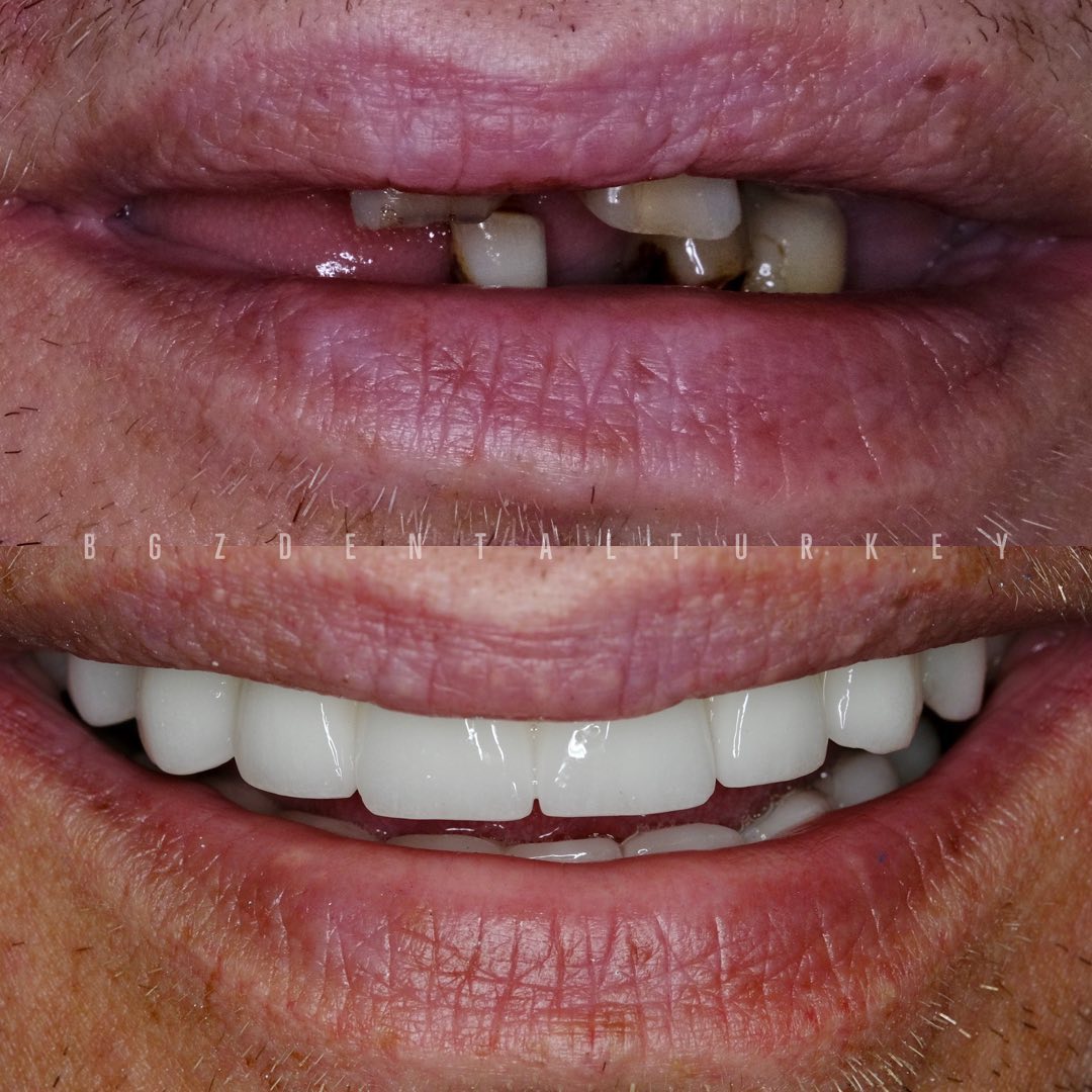 Before & after all on six dental implants in Antalya