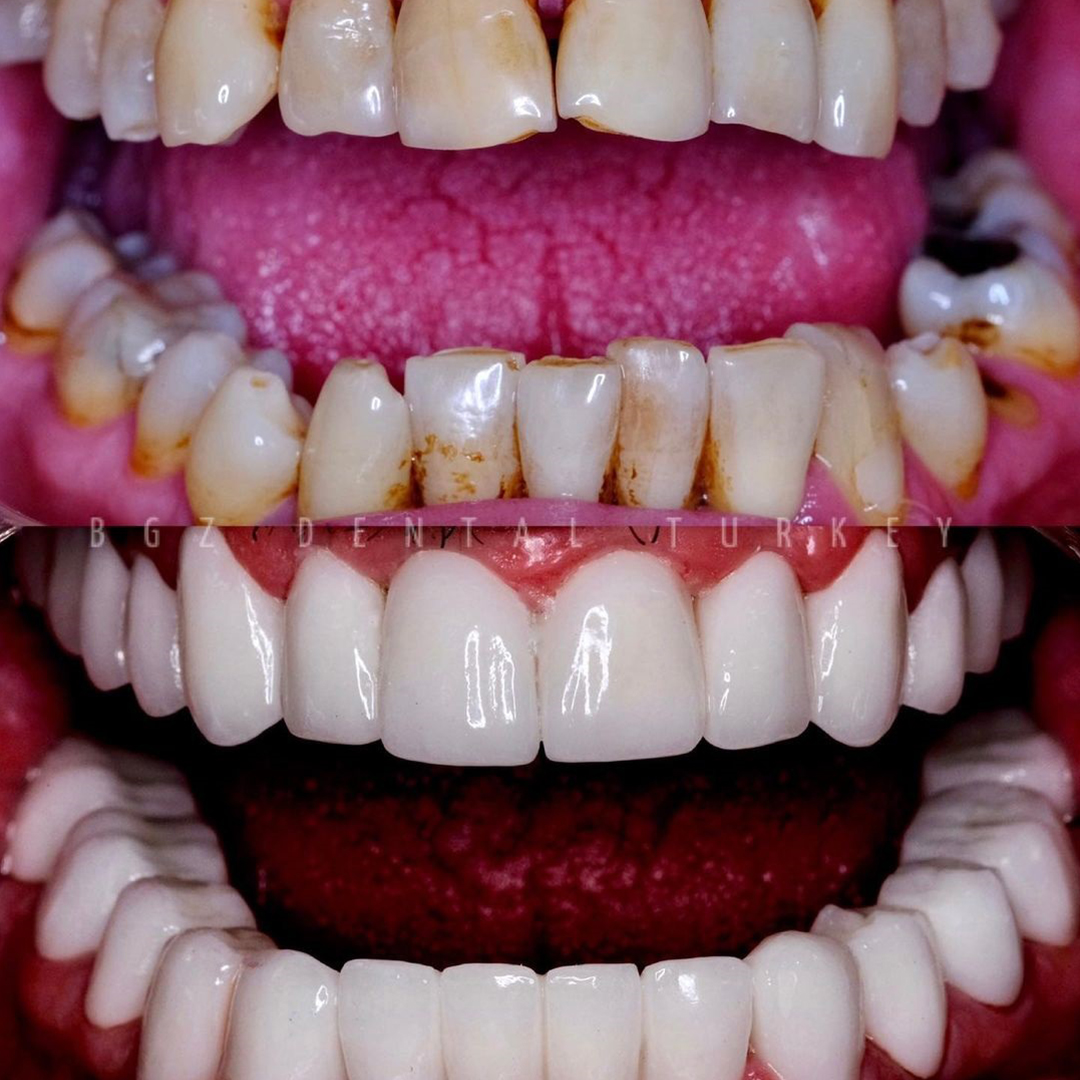 Before & after dental implant in Antalya