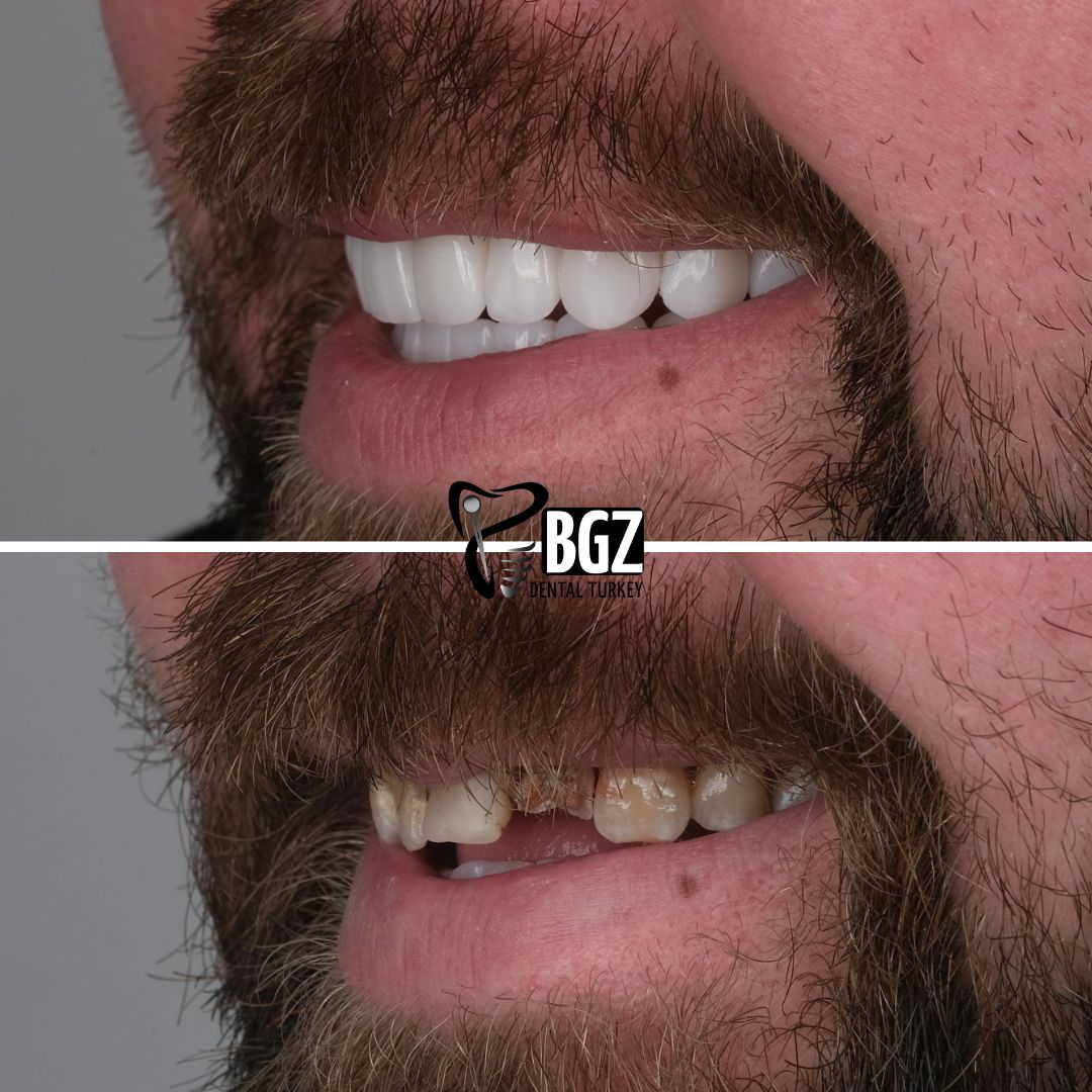 Before and After Hollywood Smile Antalya