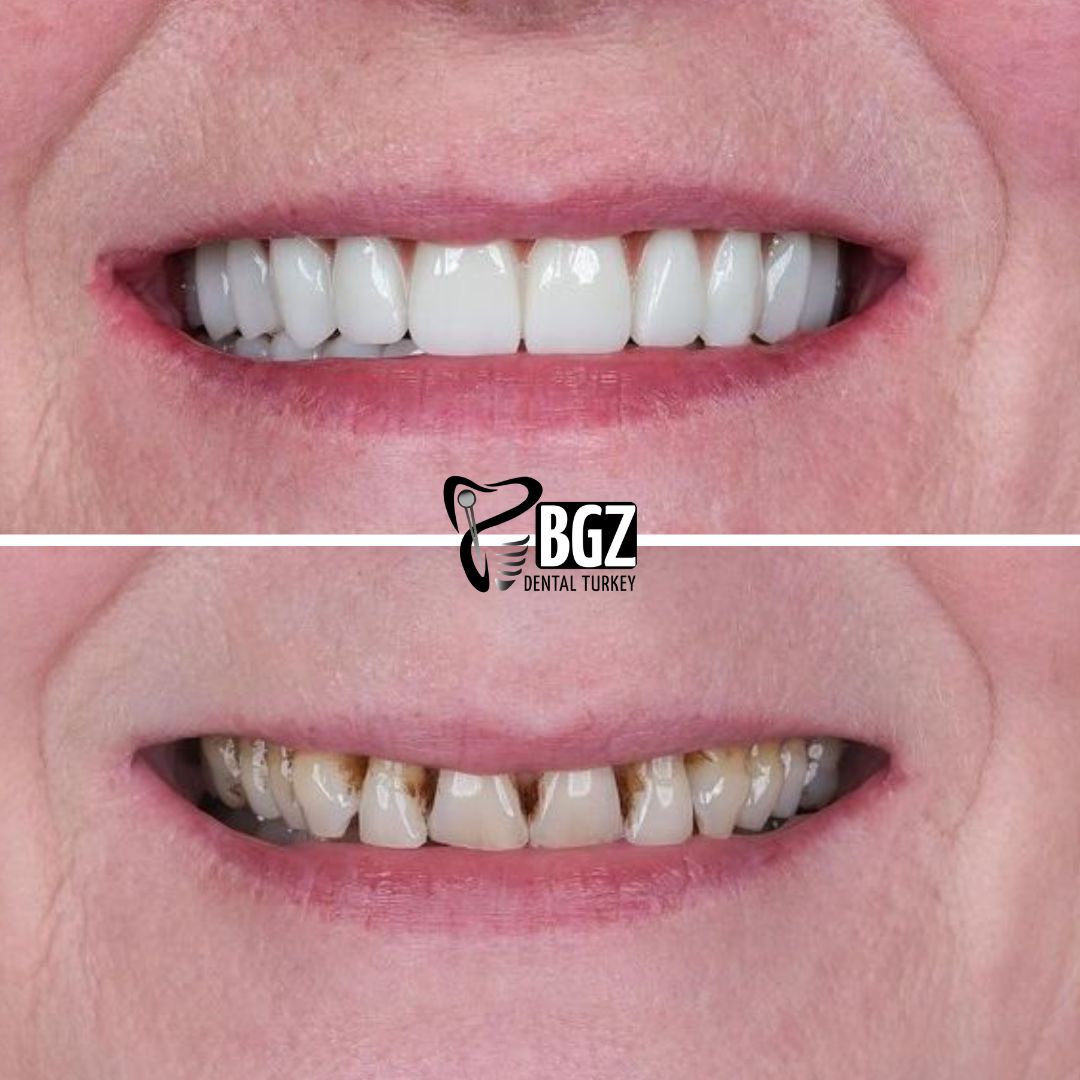 Before and After Hollywood Smile Design Turkey