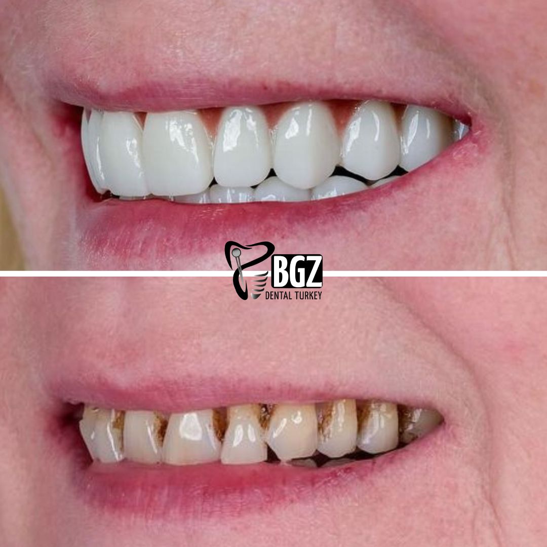 Before and After Hollywood Smile Makeover Turkey