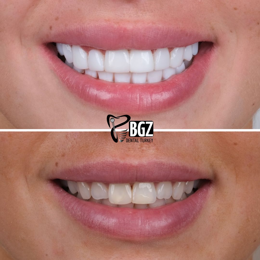 Before and After Hollywood Smile Makeover Antalya