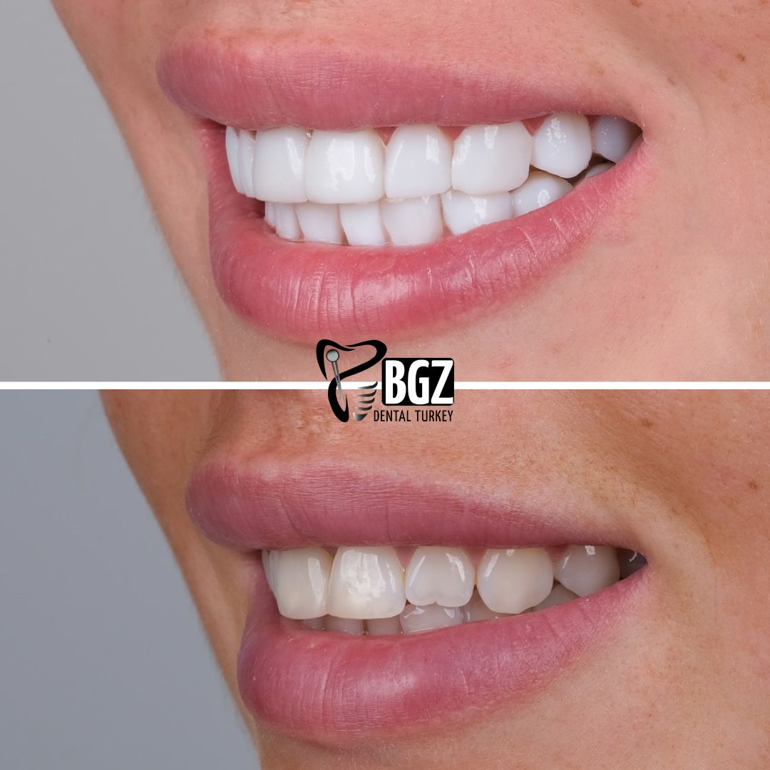 Before and After Hollywood Smile Design Antalya