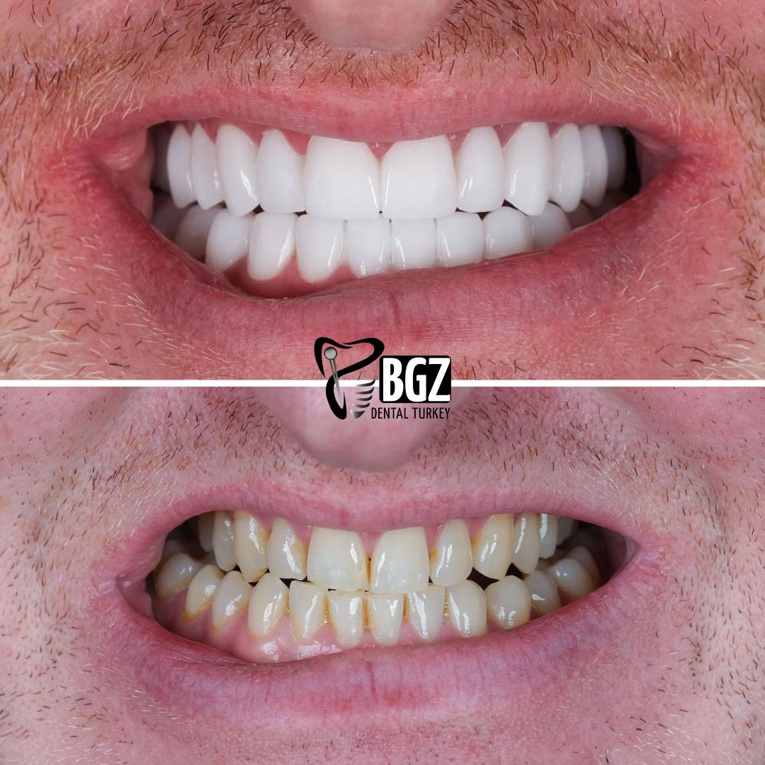 Before and After Smile Design Antalya