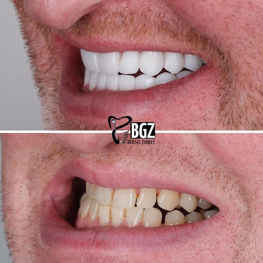 Before and After Smile Makeover Antalya