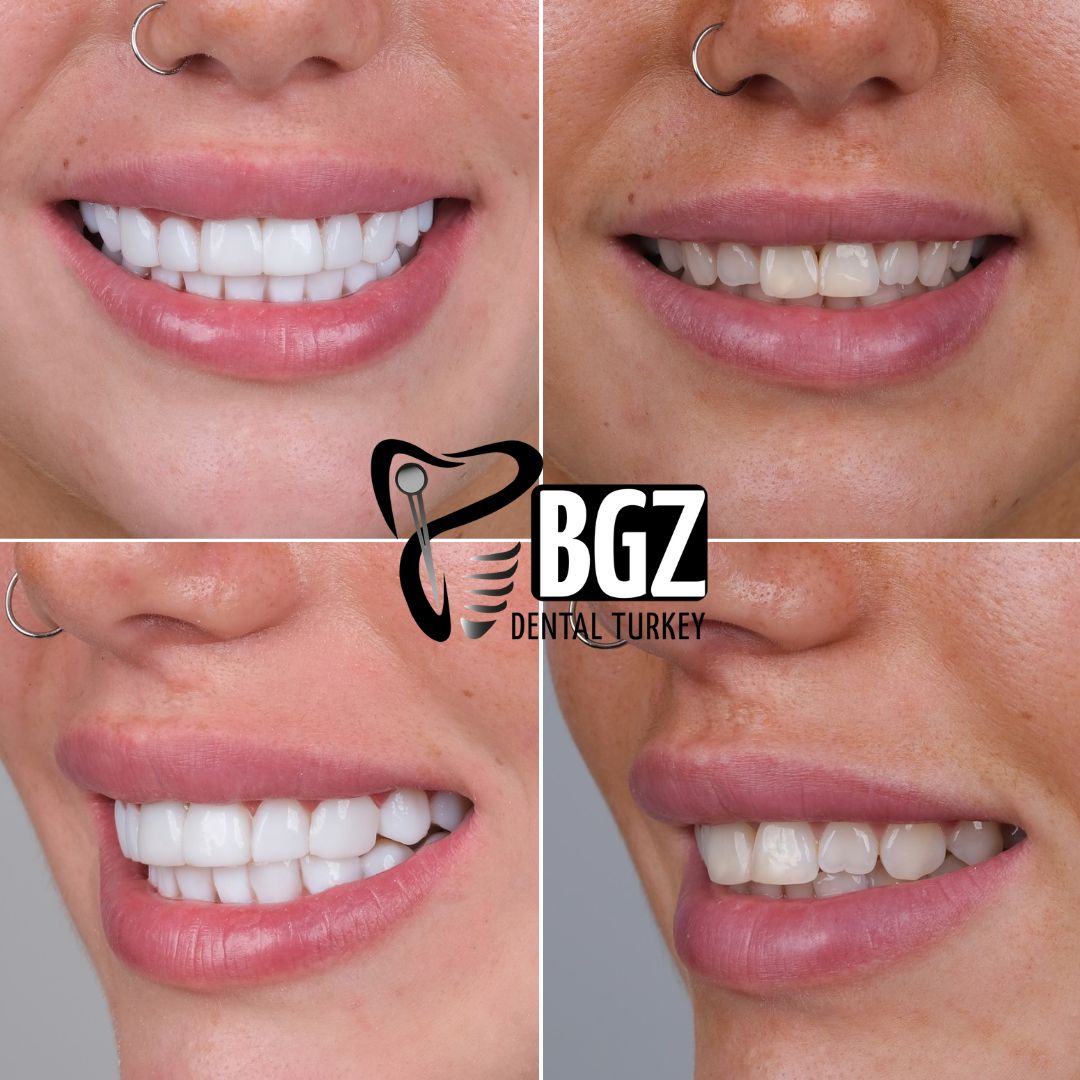 Before and After Hollywood Smile Turkey