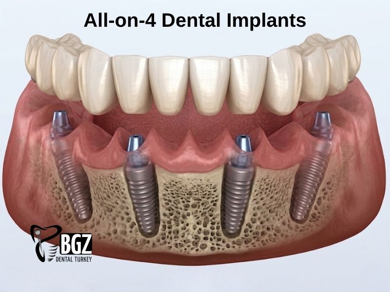 All on Four Dental Implants Turkey