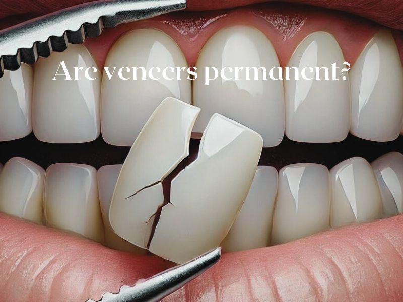 Are veneers permanent?
