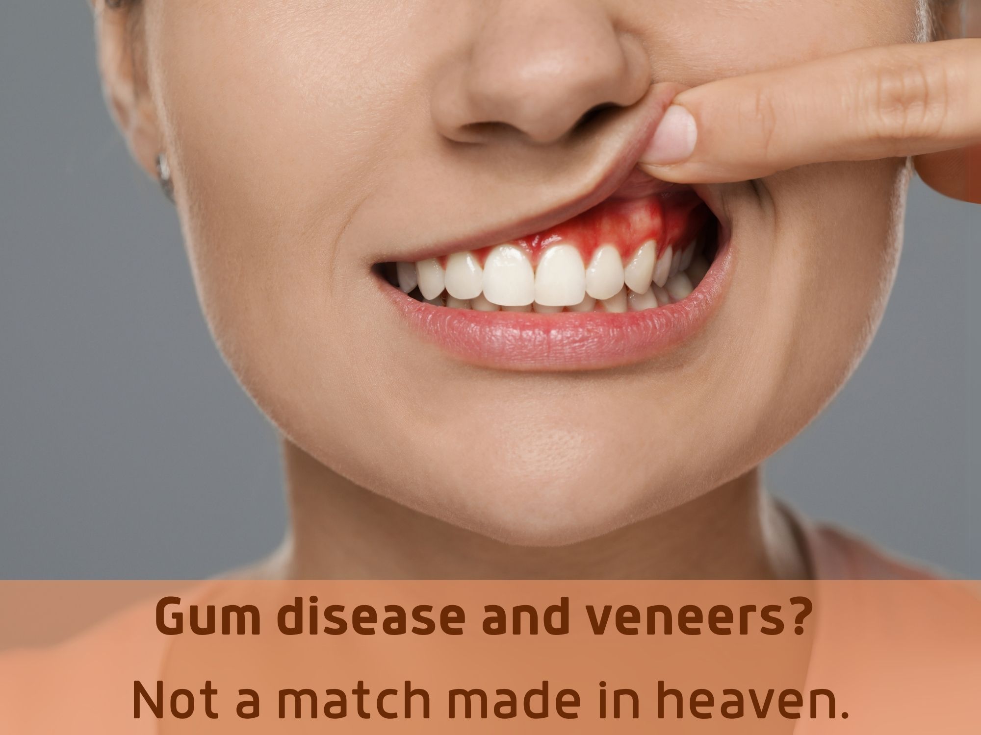 Can You Get Veneers with Gum Disease?
