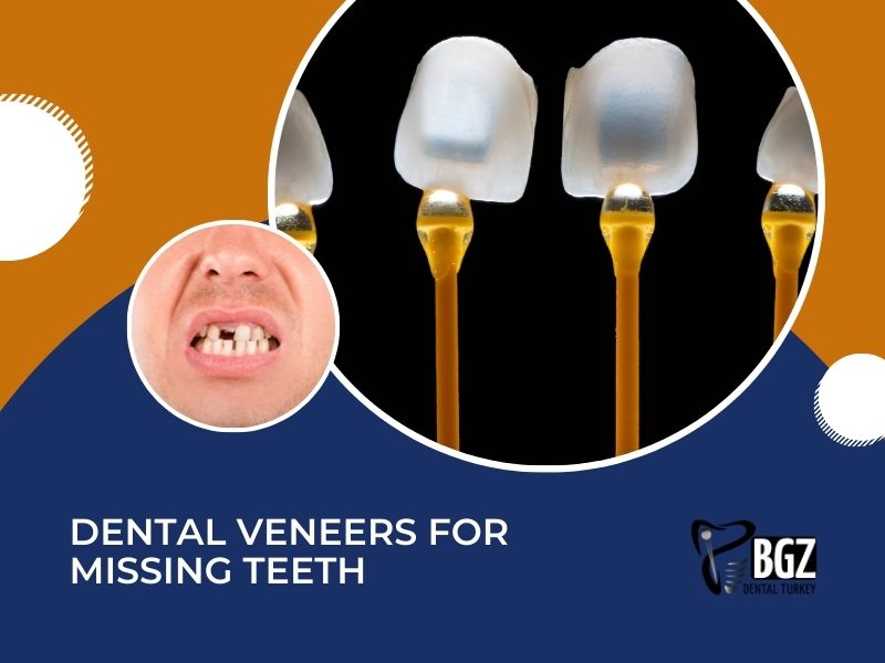 Dental Veneers for Missing Teeth: What You Should Know