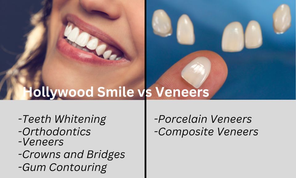 Hollywood Smile vs Veneers
