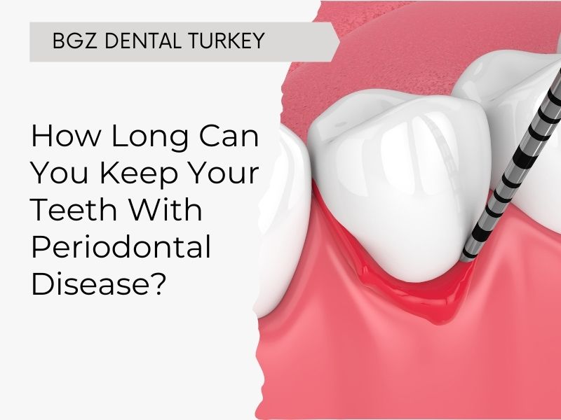 How Long Can You Keep Your Teeth With Periodontal Disease?