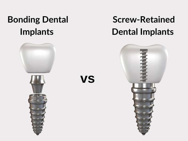 Are veneers permanent?