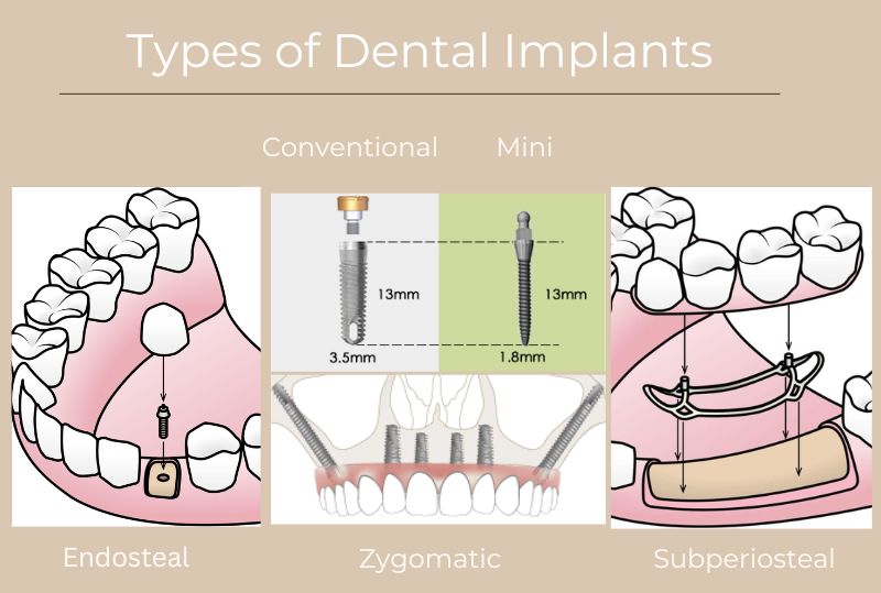 dental-implant-antalya