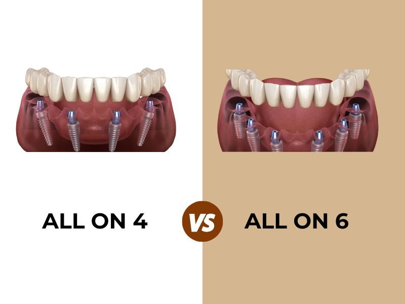 Which Is Better All-On-4 Or All-On-6 Dental Implants?