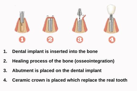 dental-implant-antalya