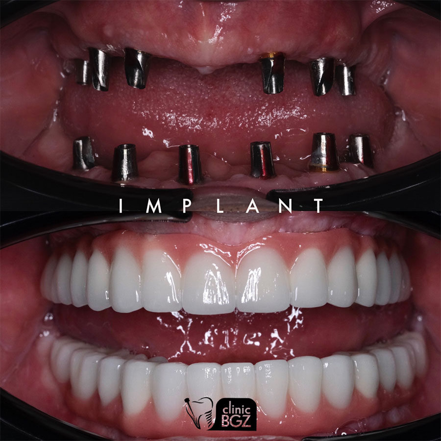 Dental implant antalya