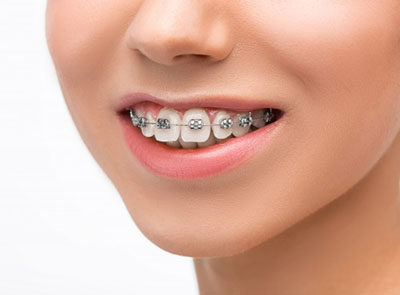 orthodontics treatments antalya